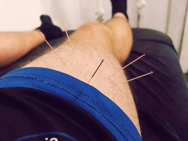 Accupuncture being performed on the leg.