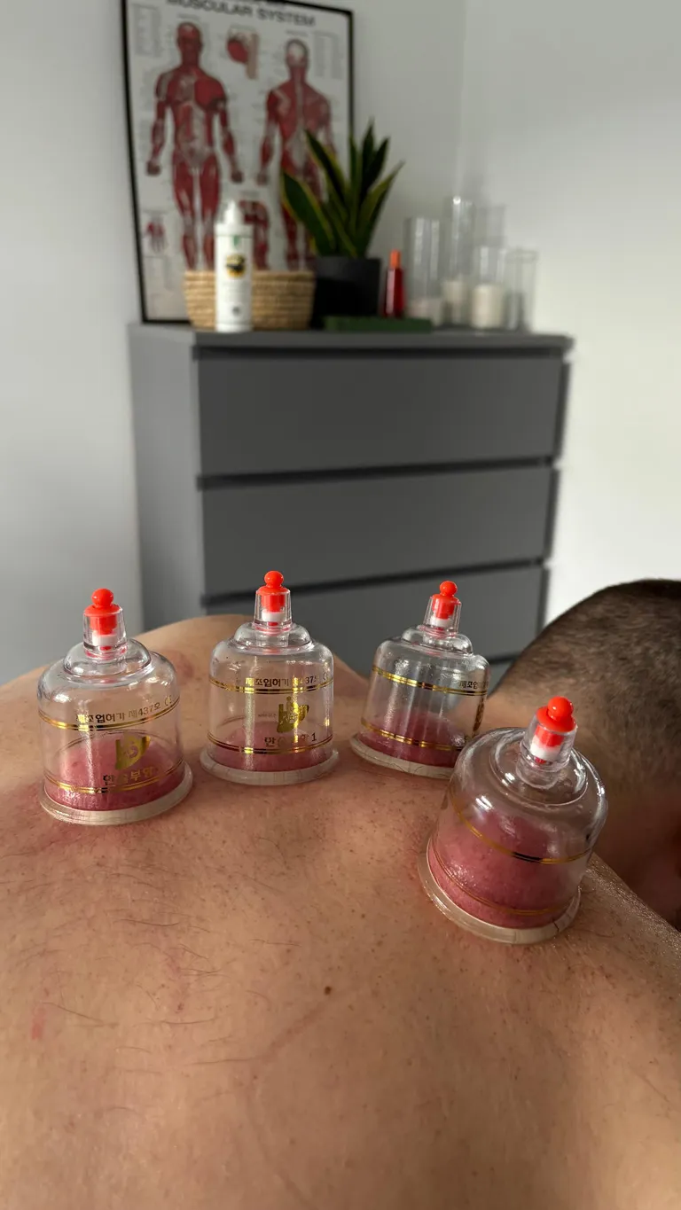 Dry cupping being performed on the clients upper back.