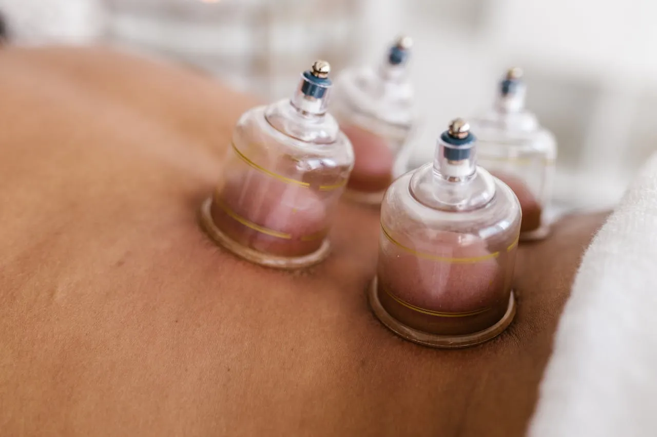 Cupping Therapy session - cupping therapy being performed on a clients back.