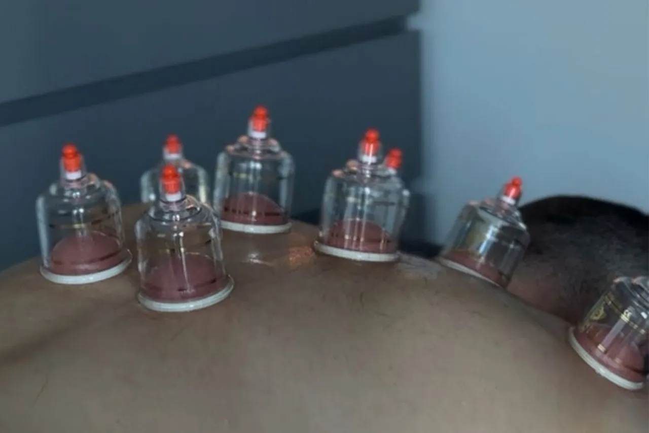 Cupping Therapy session - cupping therapy being performed on a clients back.